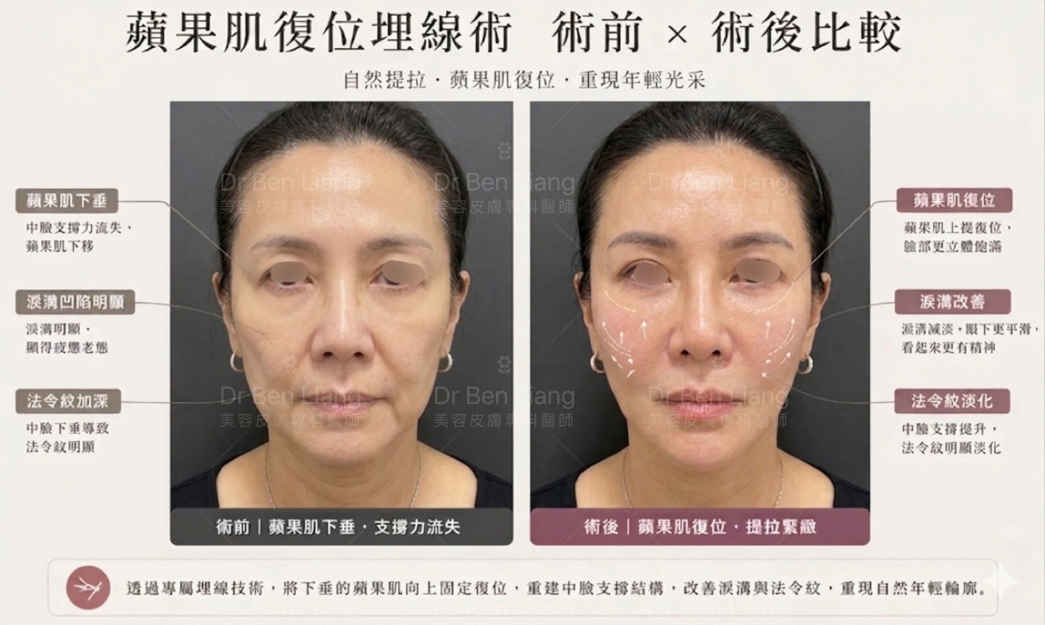 蘋果肌復位埋線術前術後比較